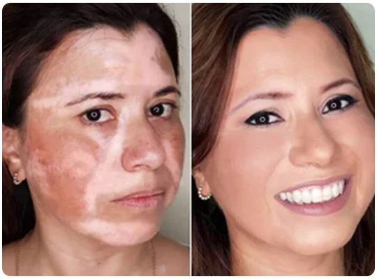 Спрей від вітіліго