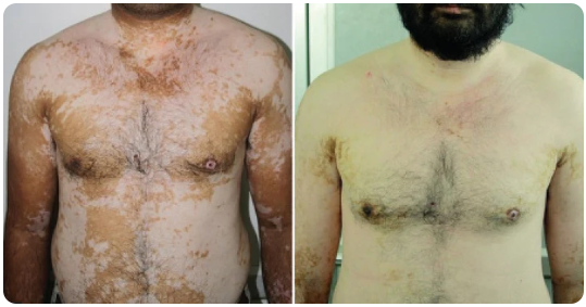 Спрей від вітіліго